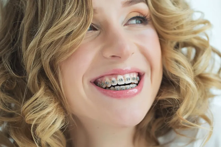 Close-up of traditional metal braces offered at Superior Orthodontics in Metro Detroit, MI